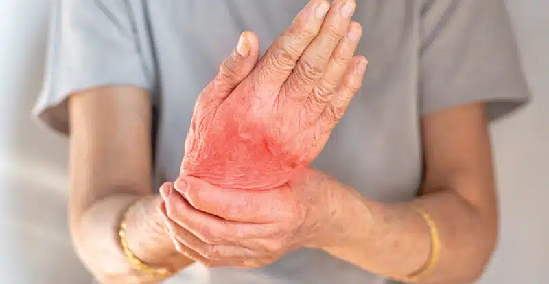 A Woman Experiencing Pain In Her Right Wrist Due To Rheumatoid Arthritis.