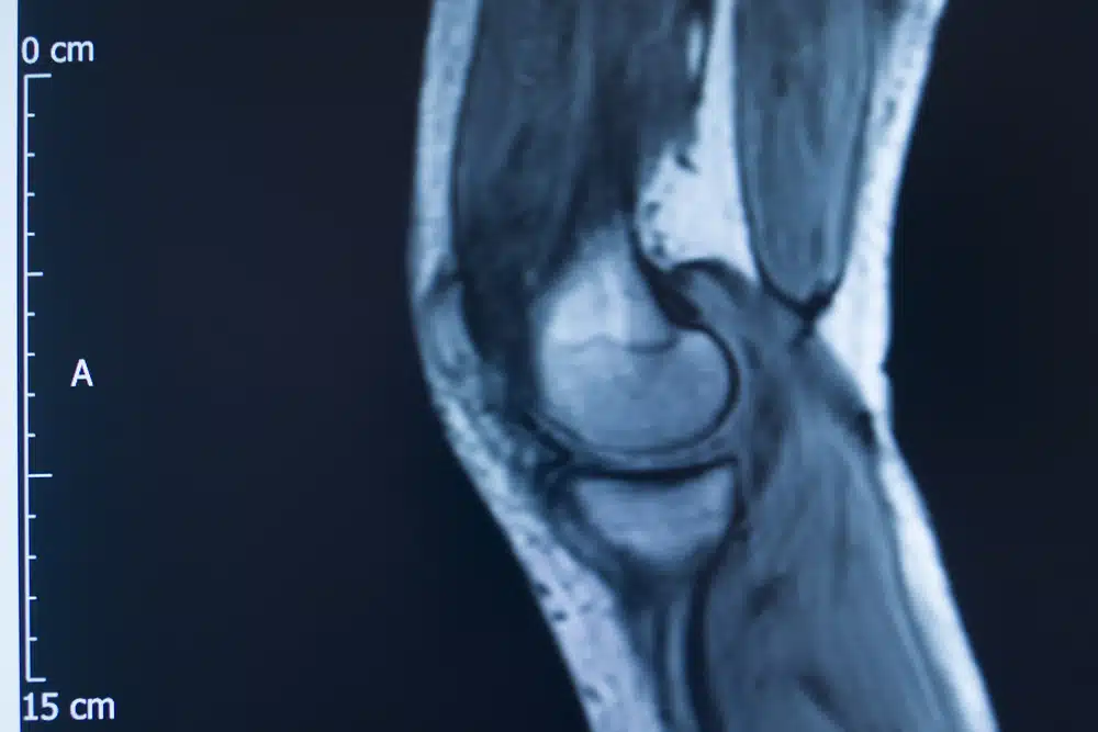 An MRI scan of a knee.